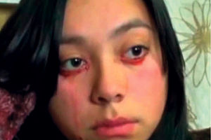 TEŠKE SUZE: Devojka iz Čilea stalno plače krv!